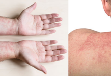 ¿Es alergia o dermatitis por calor? Conoce las diferencias y cuándo acudir al médico