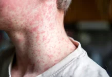 Brote de sarampión lleva a Nueva York a reforzar medidas sanitarias